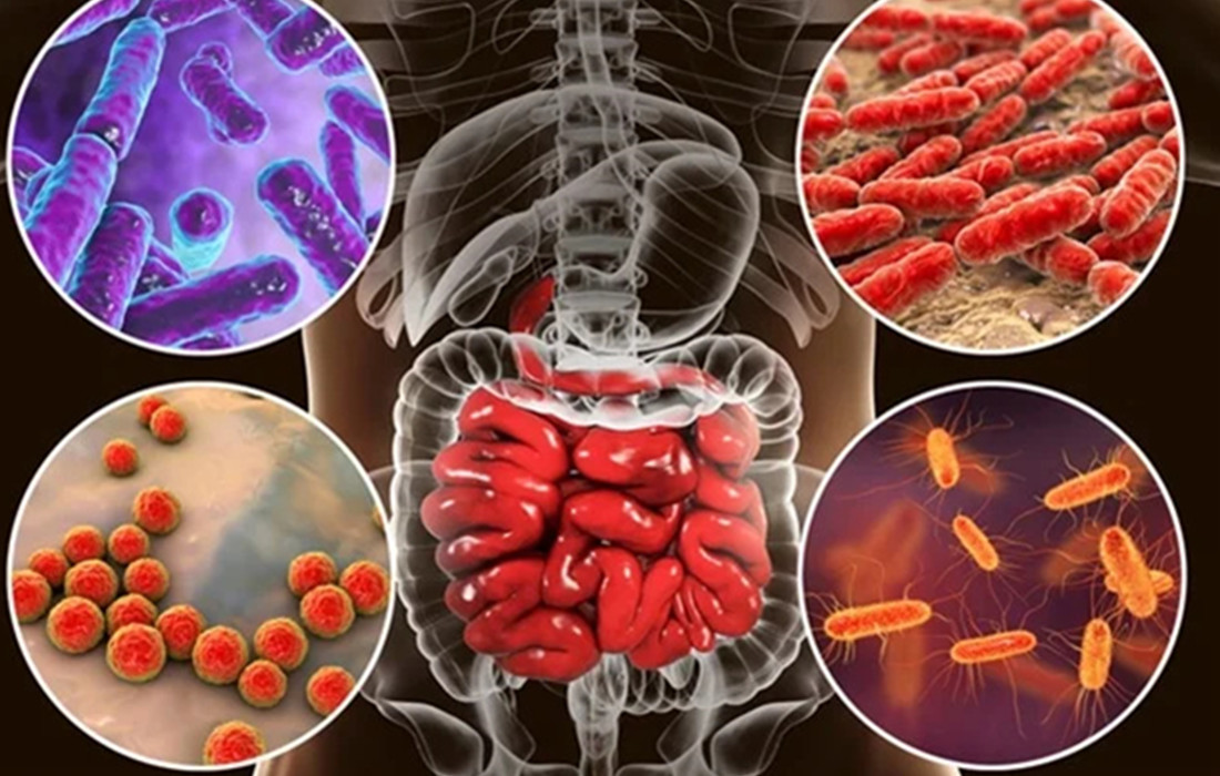 Exploring The Impact Of Microbiome Differences On Rectal Cancer Treatment